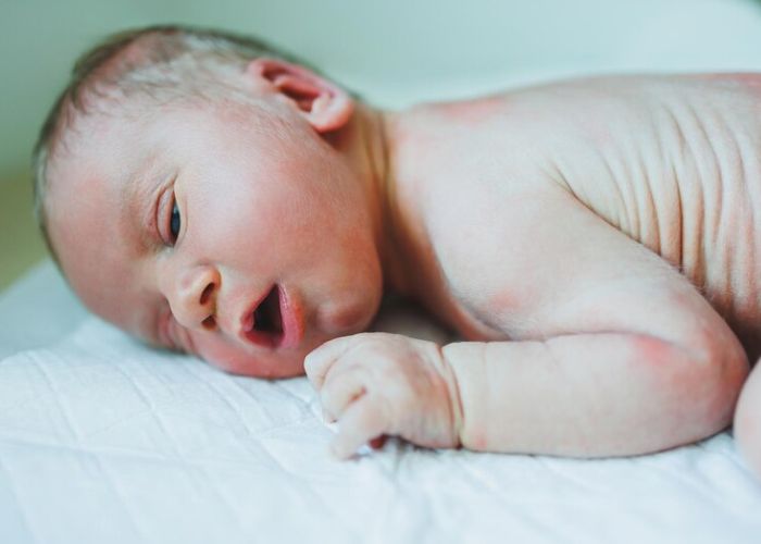 Cara Menghilangkan Gatal karena Alergi Minyak Kayu Putih pada Bayi