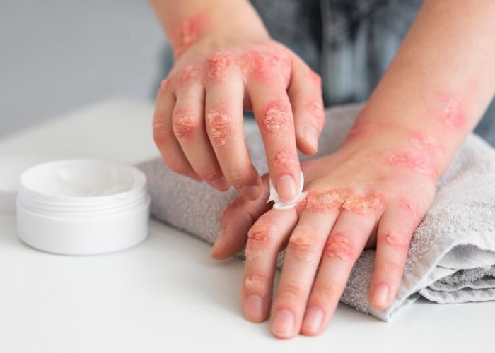 Dermatitis Kontak Alergi