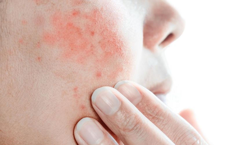 dermatitis di wajah